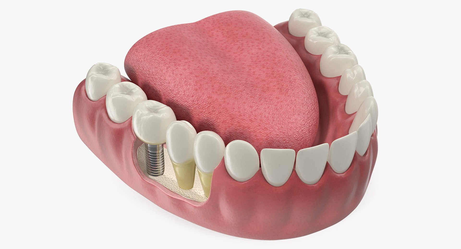 牙齿舌头医疗模型与牙种植体3d模型