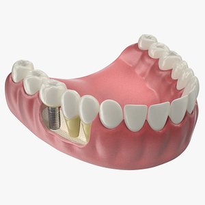 Lower Teeth Medical Model With Dental Implant