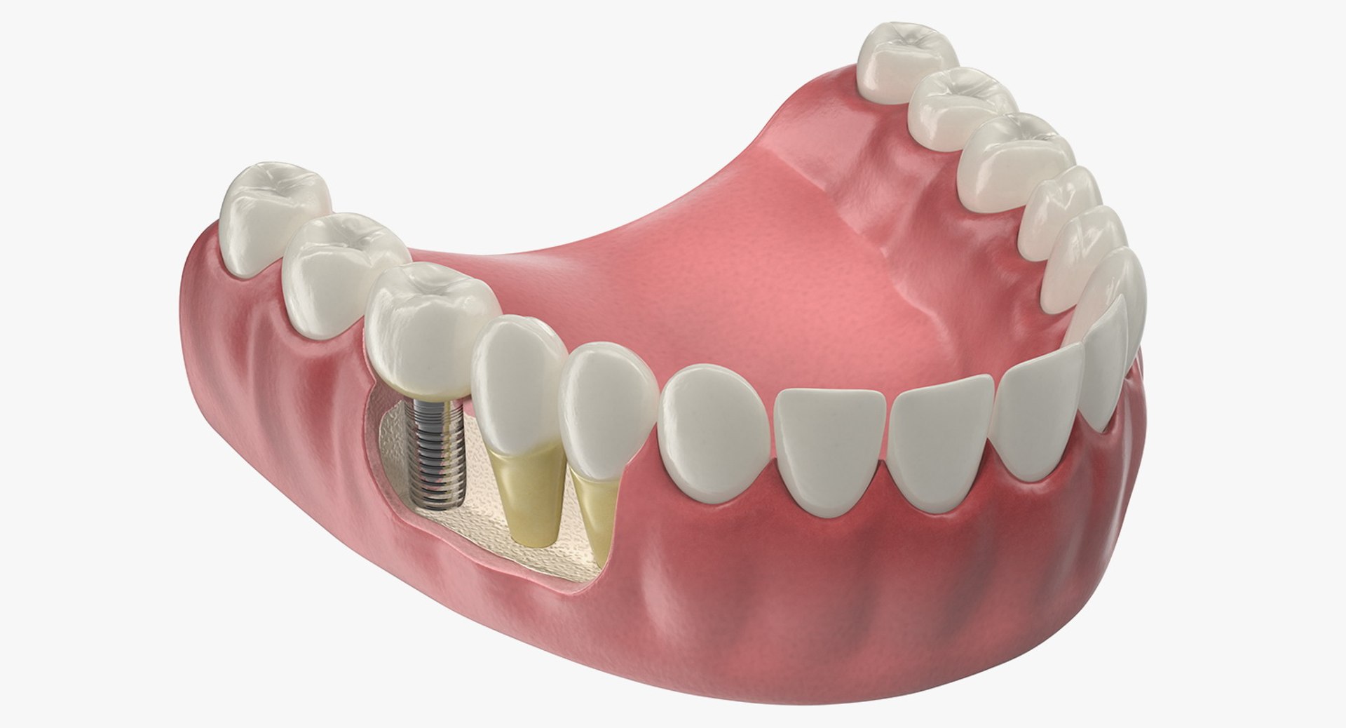 Lower Teeth Medical Model With Dental Implant 3D model preview