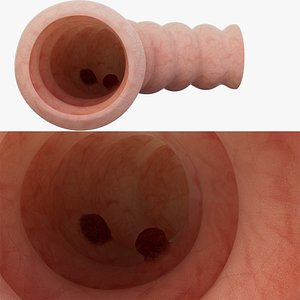 Rectal cancer intestinal tumor animation Human organ