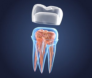 transparent crown endodontics inner 3D