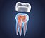 Transparent tooth and crown. 3d model of endodontics inner structure