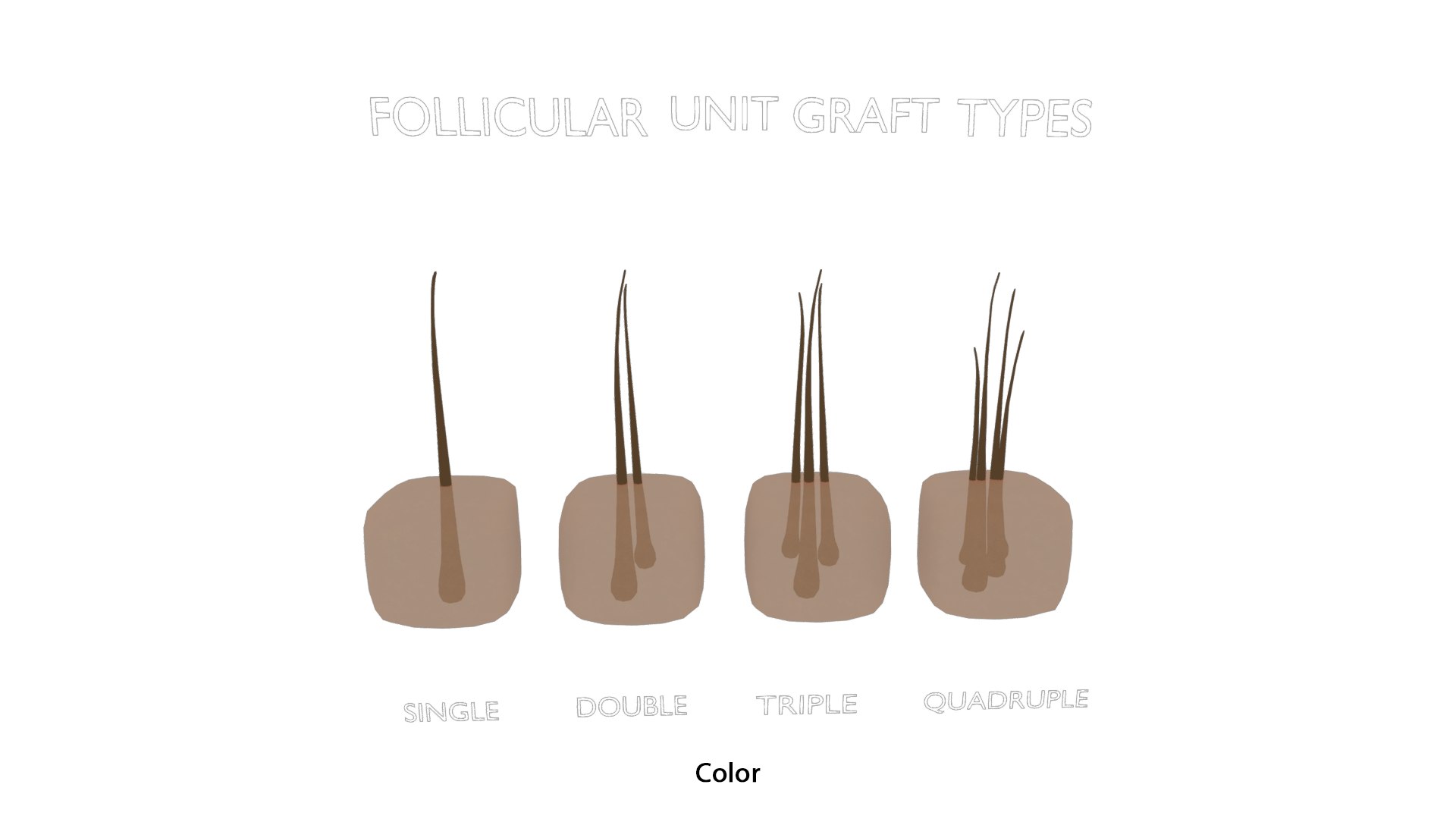 3D Follicular Unit Graft Types model https://p.turbosquid.com/ts-thumb/af/6uCXiA/3x/follicular_unit_graft_types_color/png/1766048201/1920x1080/fit_q87/91b38701eb311a8fb756a376220b879abc925da0/follicular_unit_graft_types_color.jpg