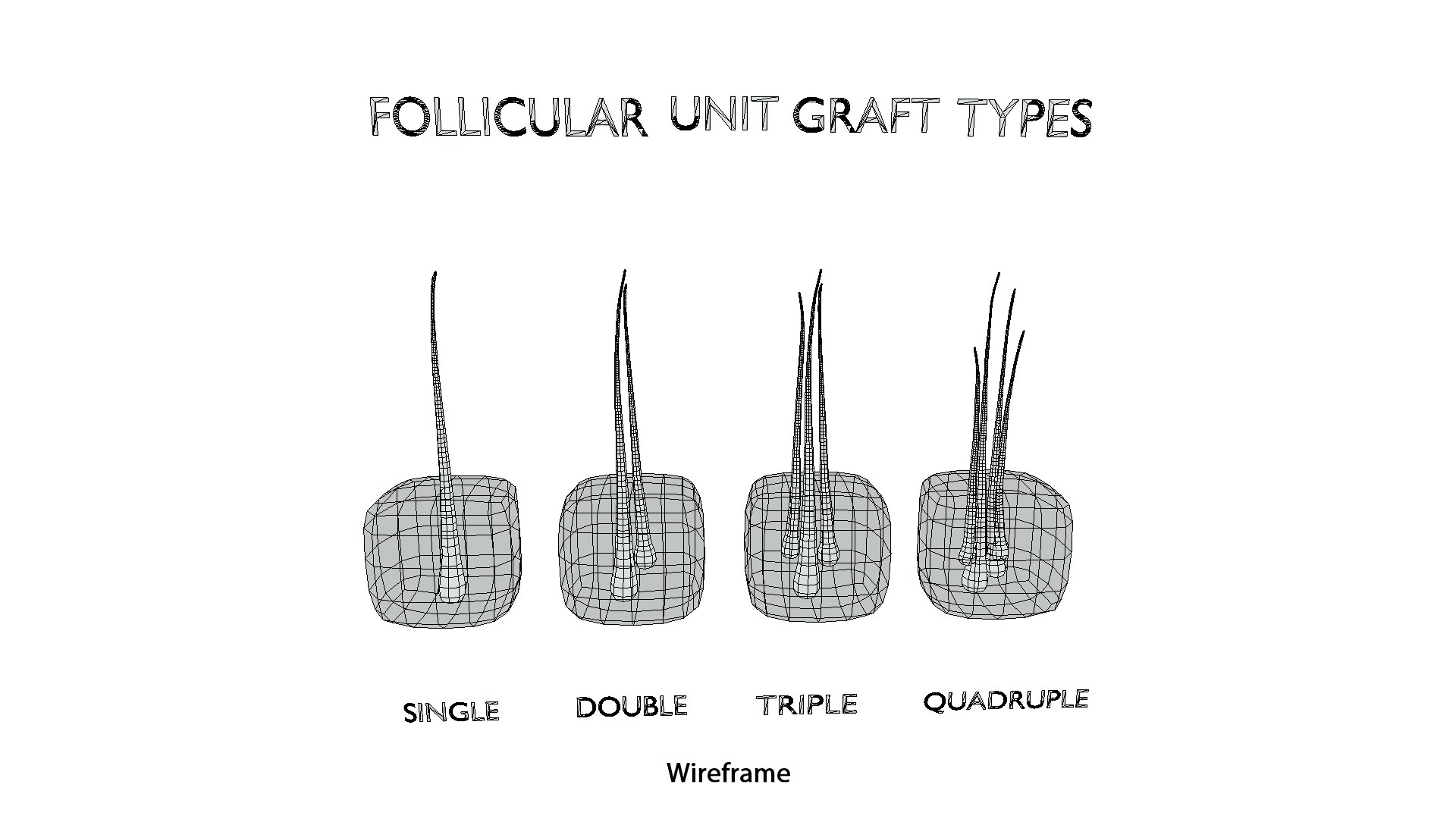3D Follicular Unit Graft Types model https://p.turbosquid.com/ts-thumb/af/6uCXiA/DU/follicular_unit_graft_types_wireframe/png/1766048198/1920x1080/fit_q87/a5c629e242da12fa938169fe3e85552af9e26e4a/follicular_unit_graft_types_wireframe.jpg
