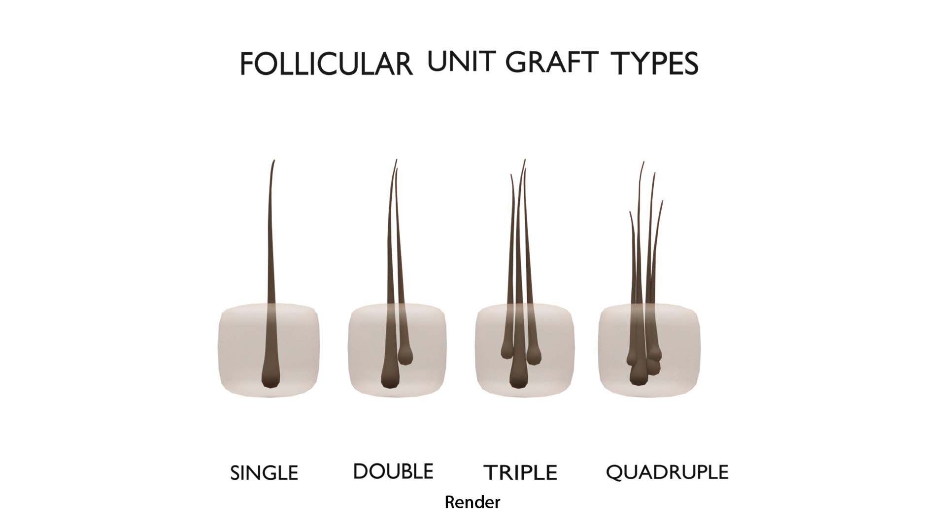 3D Follicular Unit Graft Types model https://p.turbosquid.com/ts-thumb/af/6uCXiA/Gp/follicular_unit_graft_types_render_0/png/1766048204/1920x1080/fit_q87/9a799fa68ed5d3e677589148b882720159b97904/follicular_unit_graft_types_render_0.jpg