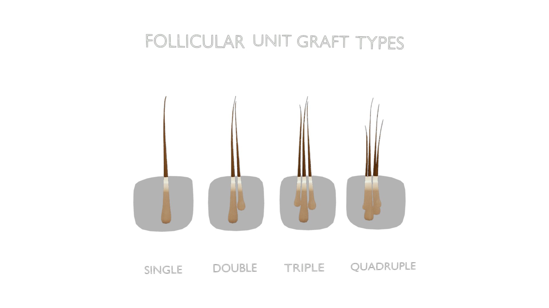 3D Follicular Unit Graft Types model https://p.turbosquid.com/ts-thumb/af/6uCXiA/vd/follicular_unit_graft_types_render_1/png/1766048204/1920x1080/fit_q87/e4898ada2ecdc4a21ddb9c036c64e1204a47ed9b/follicular_unit_graft_types_render_1.jpg