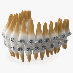 Ligature Braces on Artificial Teeth model