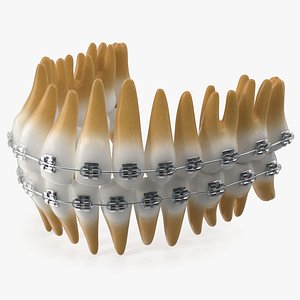 Ligature Braces on Artificial Teeth
