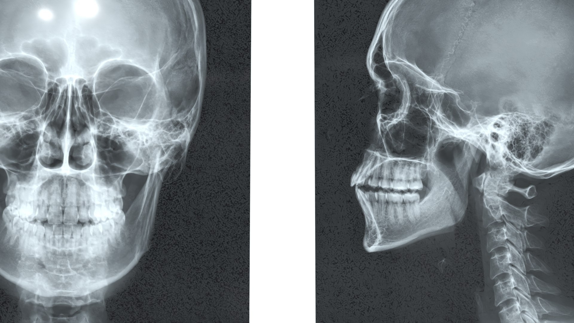 3D X Ray Lightbox with Skull Radiographs model https://p.turbosquid.com/ts-thumb/an/GCQoEV/Ww/x_ray_lightbox_with_skull_radiographs_007/jpg/1786491253/1920x1080/fit_q87/cabab836367936b8214c622fb05c283af041cea1/x_ray_lightbox_with_skull_radiographs_007.jpg