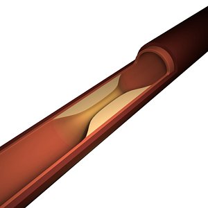 Stent