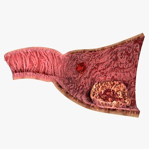 Gastric Ulcer Benign versus Malignant