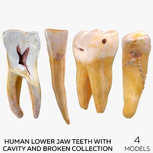 Human Lower Jaw Teeth with Cavity and Broken Collection - 4  models 3D model