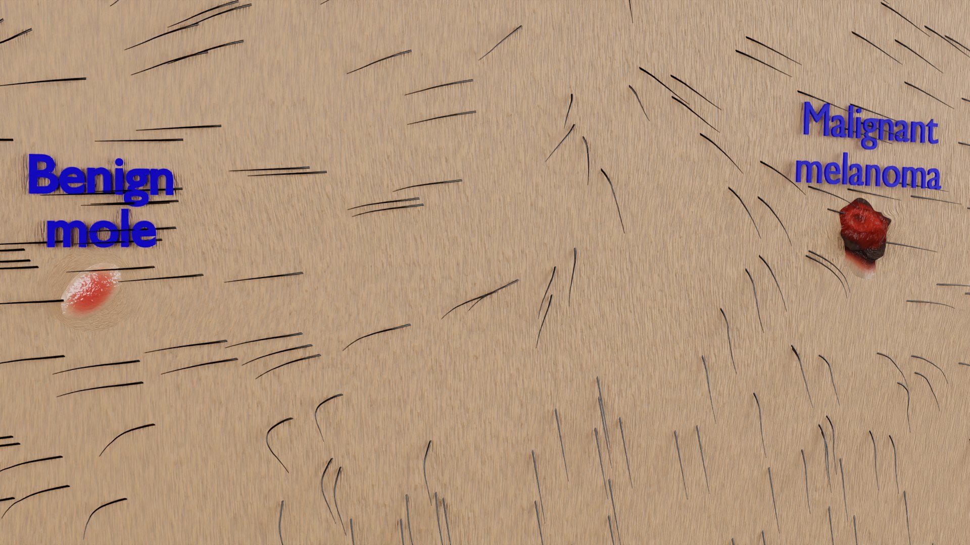 Mole nevus cancer Malignant melanoma differences 3D https://p.turbosquid.com/ts-thumb/c5/bKI6Vr/4L/ps5/png/1668228086/1920x1080/fit_q87/4e62f43363d75603b77d6acafec71b7b473a12c3/ps5.jpg