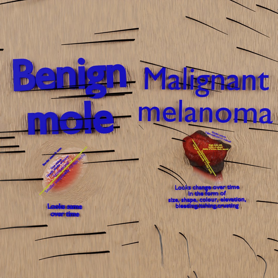 Mole nevus cancer Malignant melanoma differences 3D https://p.turbosquid.com/ts-thumb/c5/bKI6Vr/GT/1200lab/png/1668228042/1920x1080/fit_q87/1caf8800e86a14f4497c4bcfcf8a60f431459988/1200lab.jpg