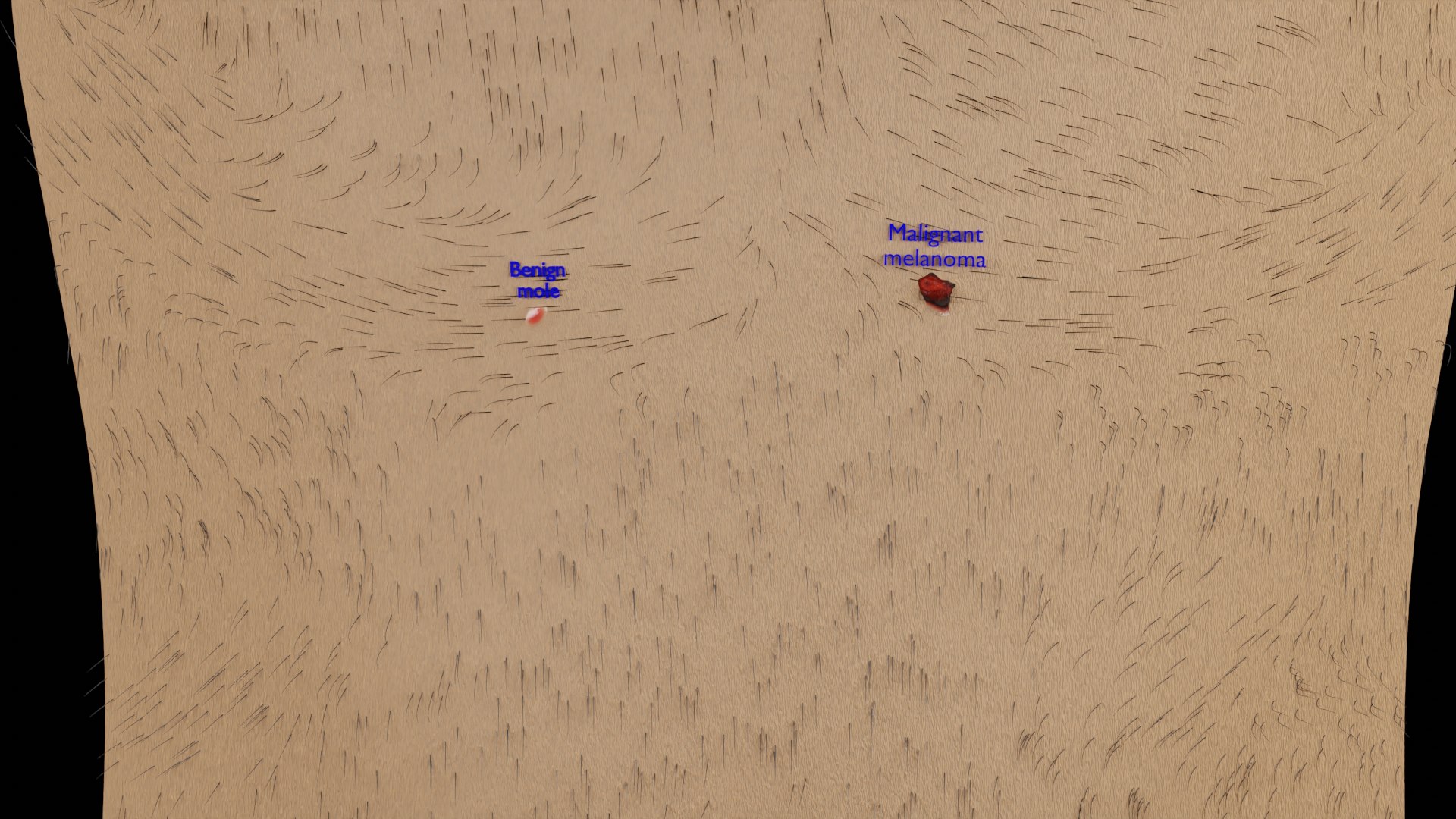 Mole nevus cancer Malignant melanoma differences 3D https://p.turbosquid.com/ts-thumb/c5/bKI6Vr/PT/ps1/png/1668228059/1920x1080/fit_q87/c98ec68ba4bc92e2c18a797d3d5f564b54ecb1eb/ps1.jpg