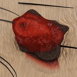 Mole nevus cancer Malignant melanoma differences 3D