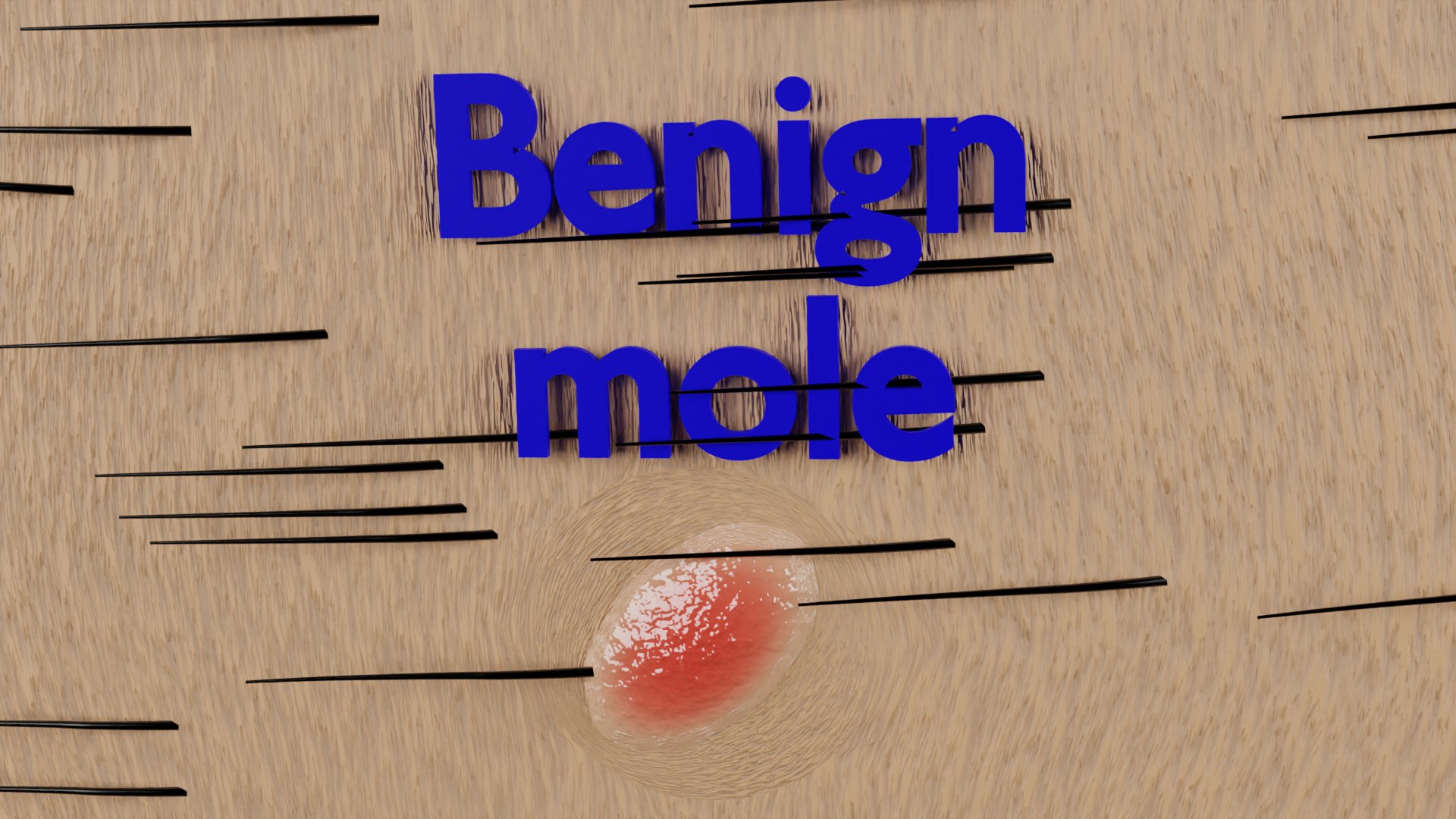 Mole nevus cancer Malignant melanoma differences 3D https://p.turbosquid.com/ts-thumb/c5/bKI6Vr/bt/ps6/png/1668228098/1920x1080/fit_q87/0ed31141e42262d22ccd2cad6bf1c9486430d866/ps6.jpg