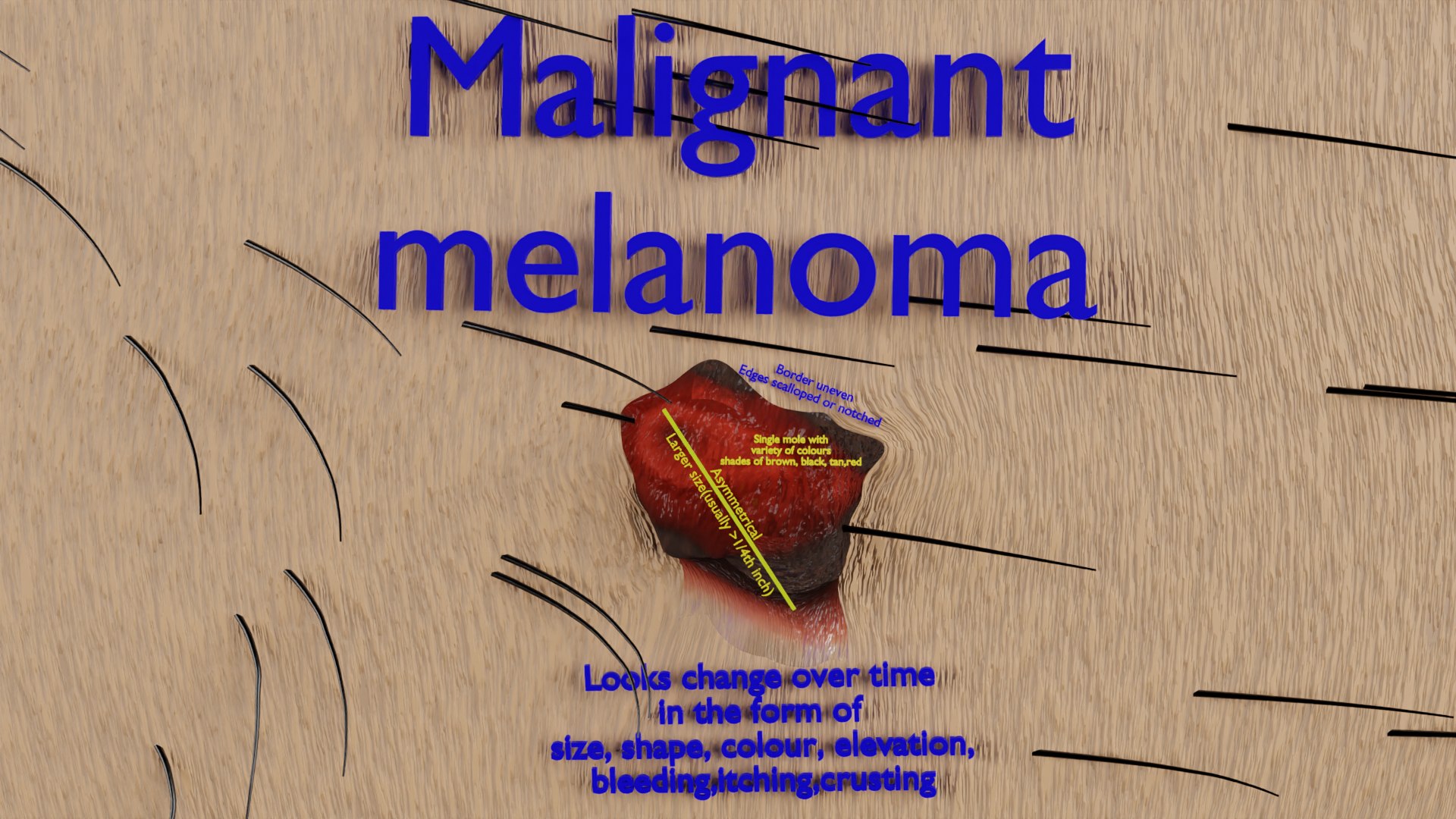Mole nevus cancer Malignant melanoma differences 3D https://p.turbosquid.com/ts-thumb/c5/bKI6Vr/fR/ps10/png/1668228054/1920x1080/fit_q87/d98c11e4e4b90d8417b221f5dc516f82fea46261/ps10.jpg