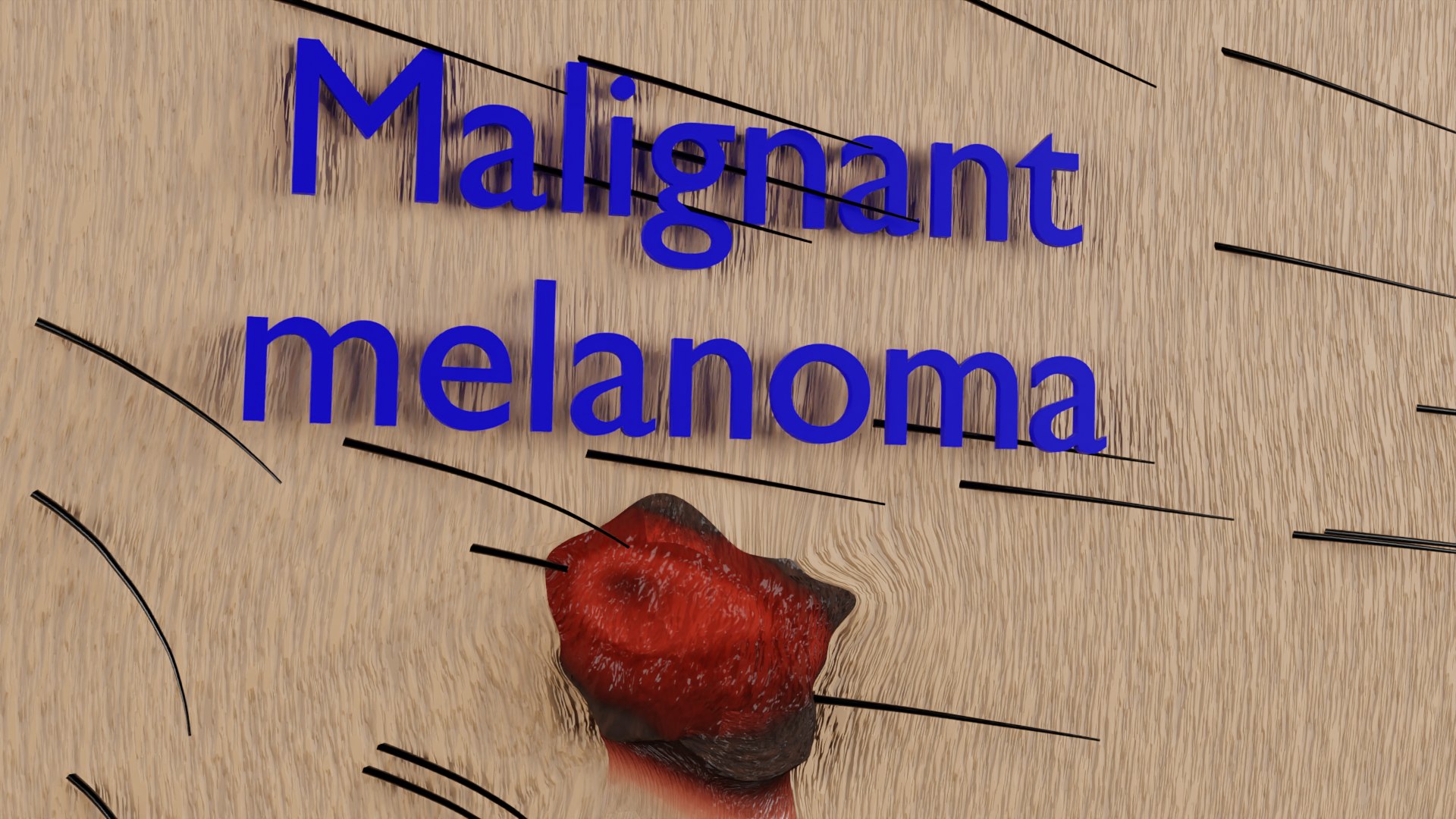 Mole nevus cancer Malignant melanoma differences 3D https://p.turbosquid.com/ts-thumb/c5/bKI6Vr/fr/ps9/png/1668228110/1920x1080/fit_q87/ba7a43d97d80a9bbf474eb6edf6a158483b2ca50/ps9.jpg