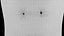 Mole nevus cancer Malignant melanoma differences