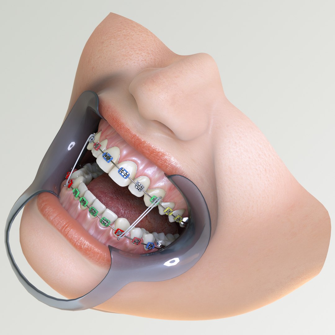 Orthodontic retainer : 14 262 images, photos de stock, objets 3D