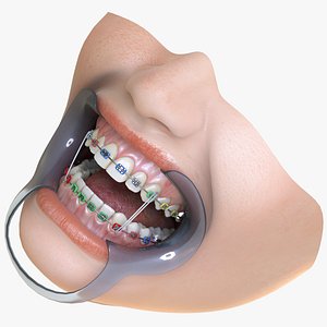 Orthodontic Mouth