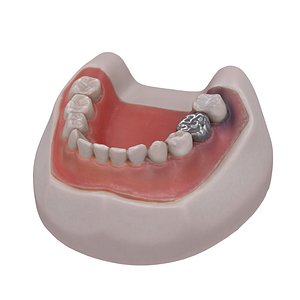 3d model of typodont scanned harvard -