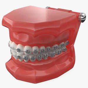 Ligature Braces on Teeth Model