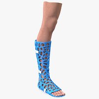 3D-Printed Orthopedic Cast On Leg