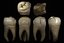 Maxillary first molar