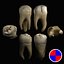 Maxillary first molar