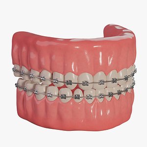 3D Teeth with self-legating braces