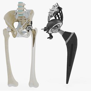 Replaced Pelvic Implant