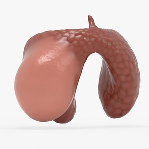 solid adenocarcinoma thyroid 3D