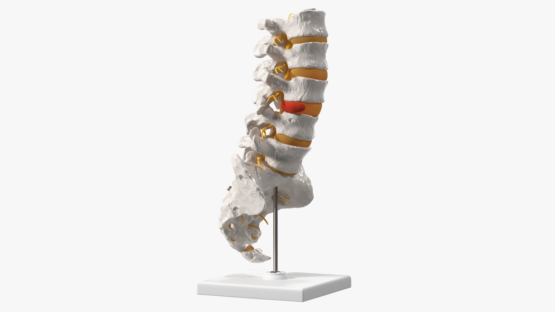 Spinal Column with Hernia on Stand 3D model preview