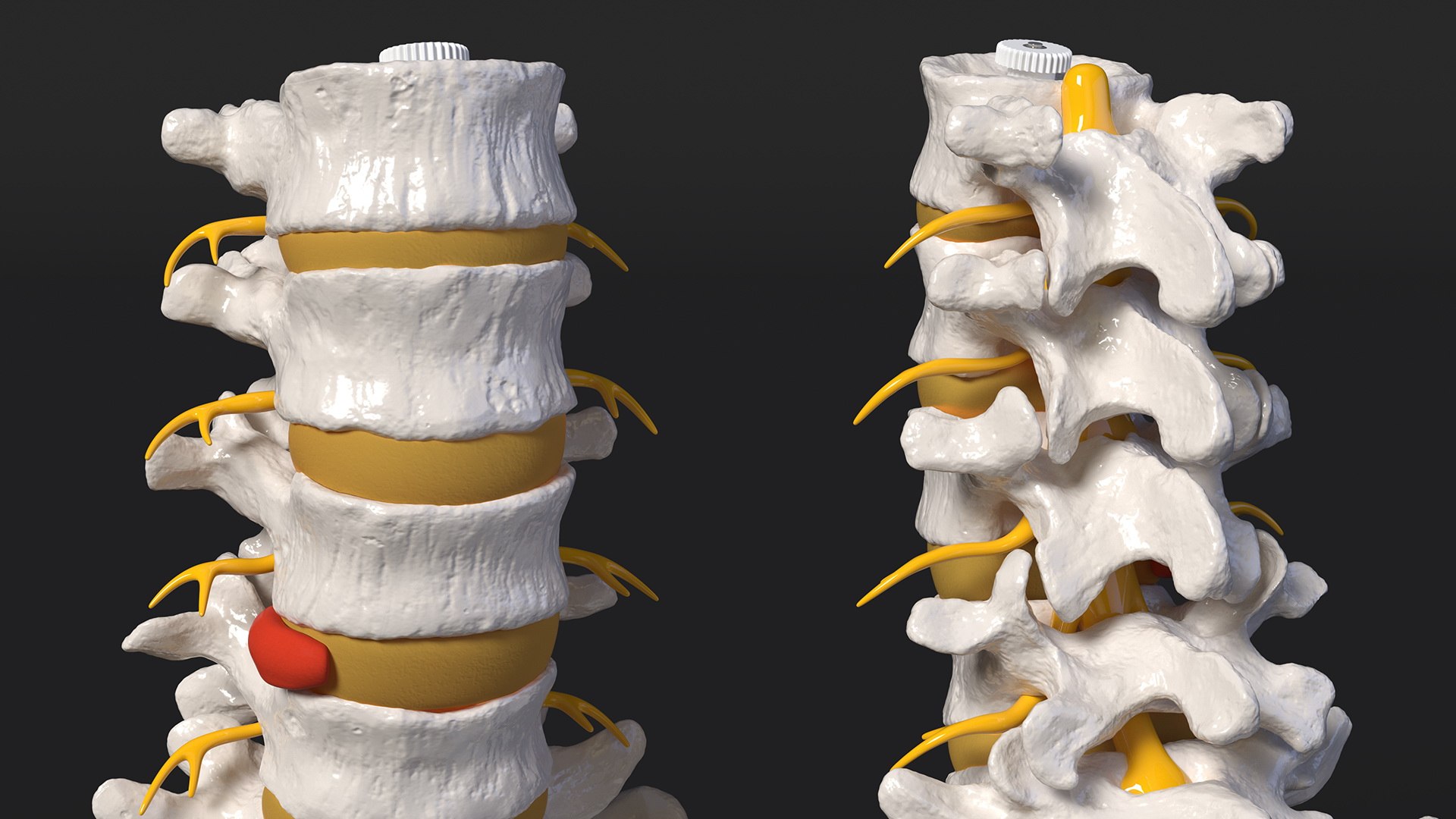 Spinal Column with Hernia on Stand 3D - TurboSquid 2051092