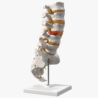 Spinal Column with Hernia on Stand