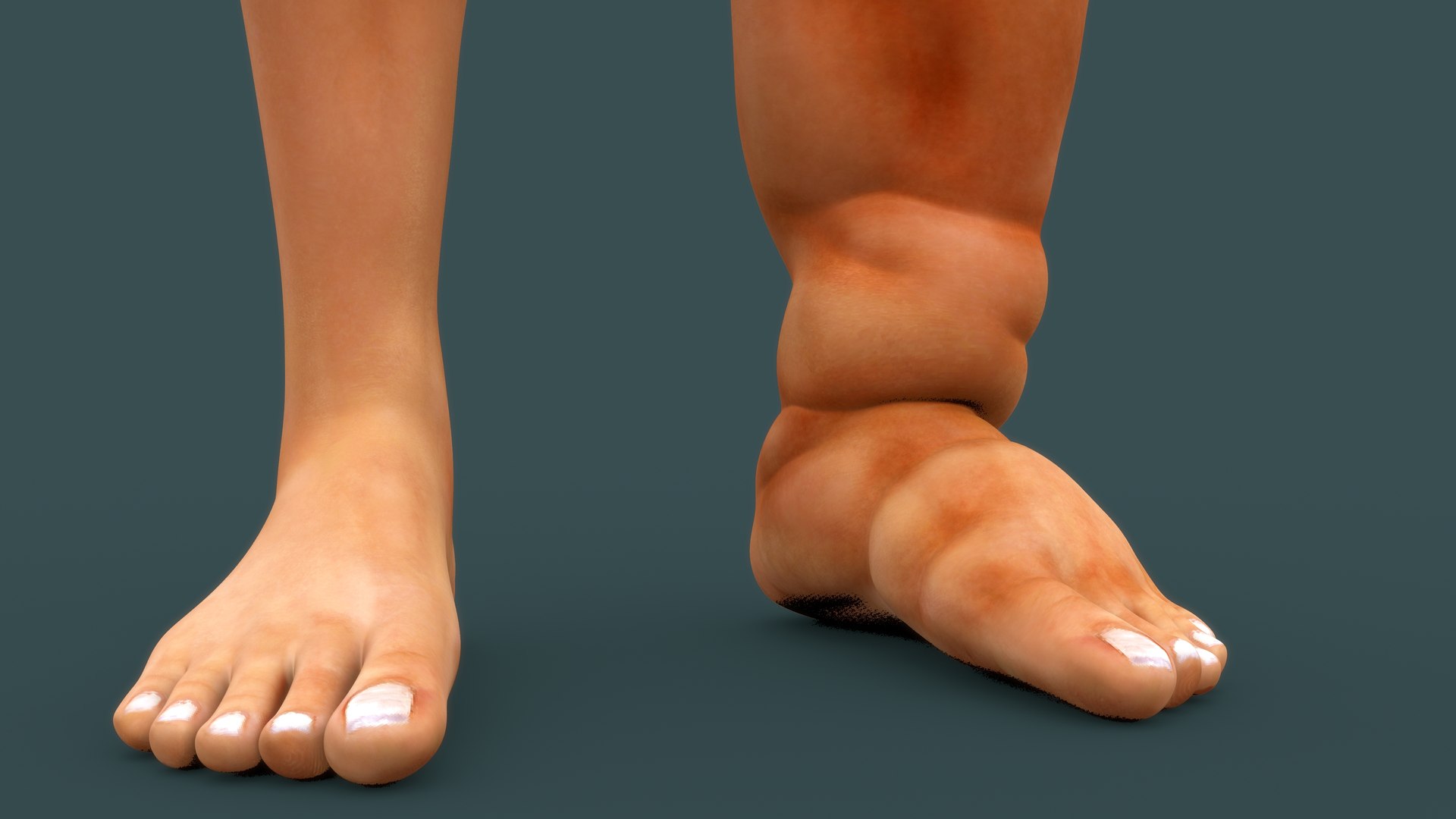 Lymphatic filariasis model https://p.turbosquid.com/ts-thumb/dn/EPqSk1/68/b0723filariasis_up/jpg/1632467665/1920x1080/fit_q87/a2120b3bf46b9e2ef4976a8409b24d32a6206416/b0723filariasis_up.jpg
