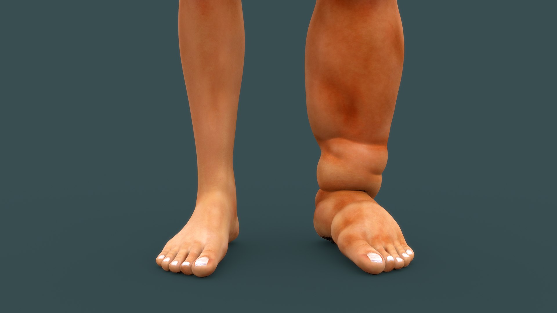 Lymphatic filariasis model https://p.turbosquid.com/ts-thumb/dn/EPqSk1/Xv/b0723filariasis_front/jpg/1632467674/1920x1080/fit_q87/2372805fcd1f85576ae81ce3bc6af44d3aa17045/b0723filariasis_front.jpg