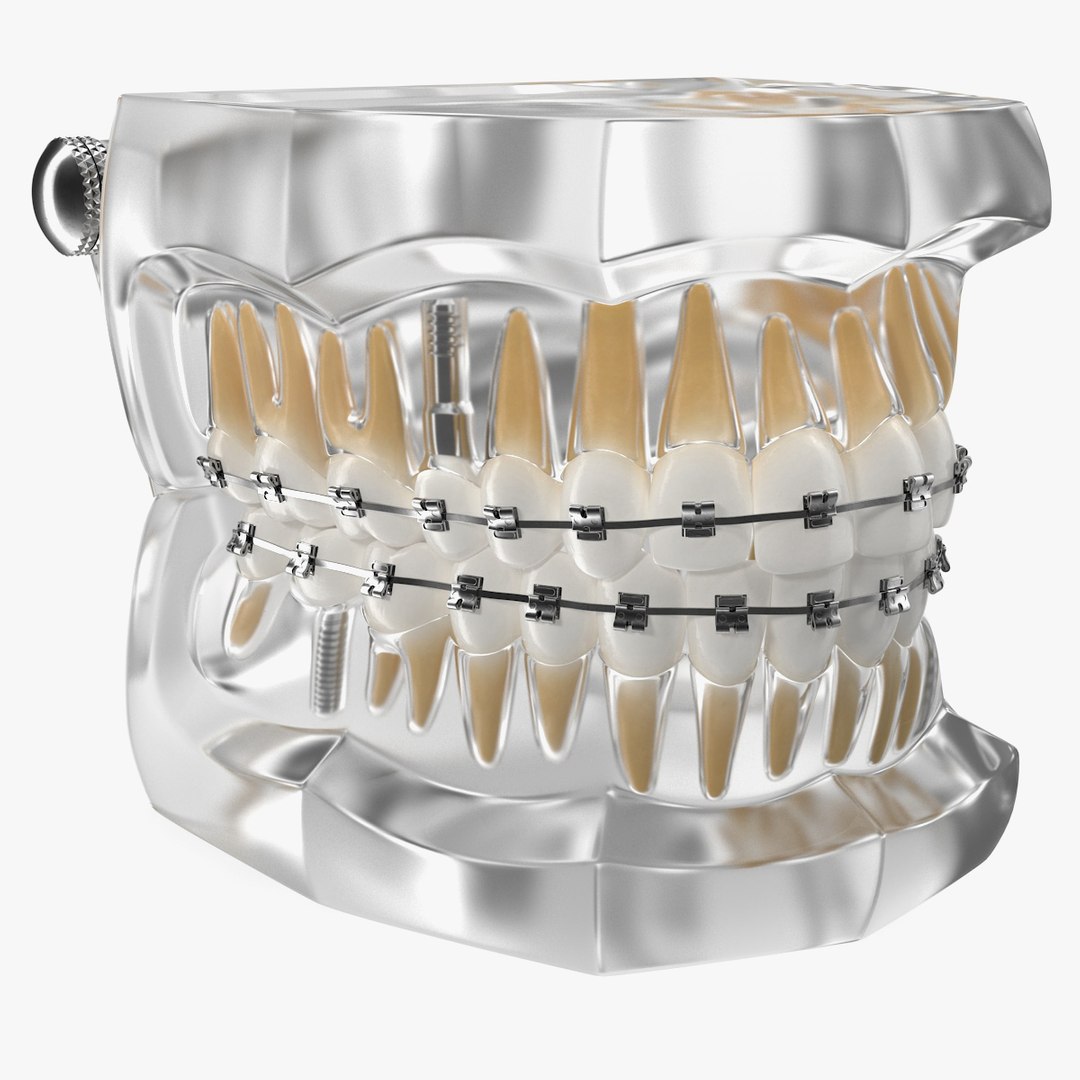 Transparent Dental Typodont With Bracket and Dental Implants 3D model preview