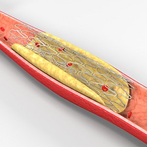 Cardiovascular stent