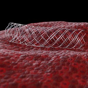 Nitinol medical stent