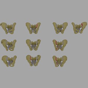 Pelvis fractures