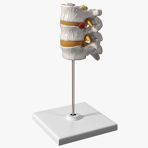 3D Herniated Vertebrae on Medical Stand model