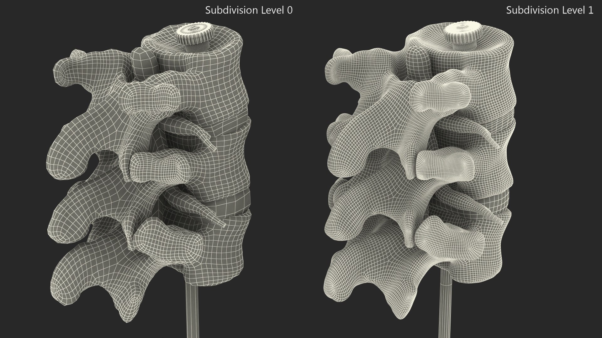 3D Herniated Vertebrae on Medical Stand model - TurboSquid 2044661