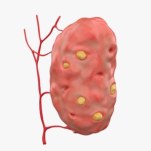 Palatine tonsil with tonsilloliths