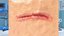 Cut Skin Surface