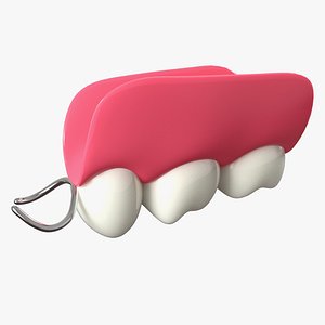 Removable Partial Denture