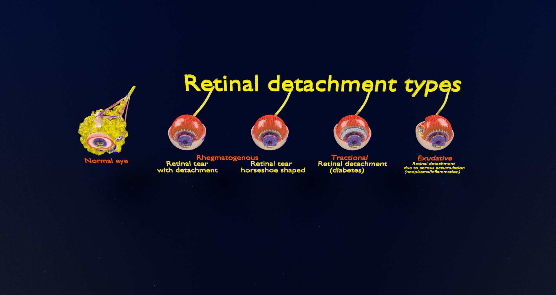 Retinal Detachment Types Eye 3D Model - TurboSquid 1774876