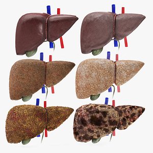 3D Liver Diseases